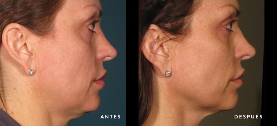 Antes y después Ultherapy Prime caso 1